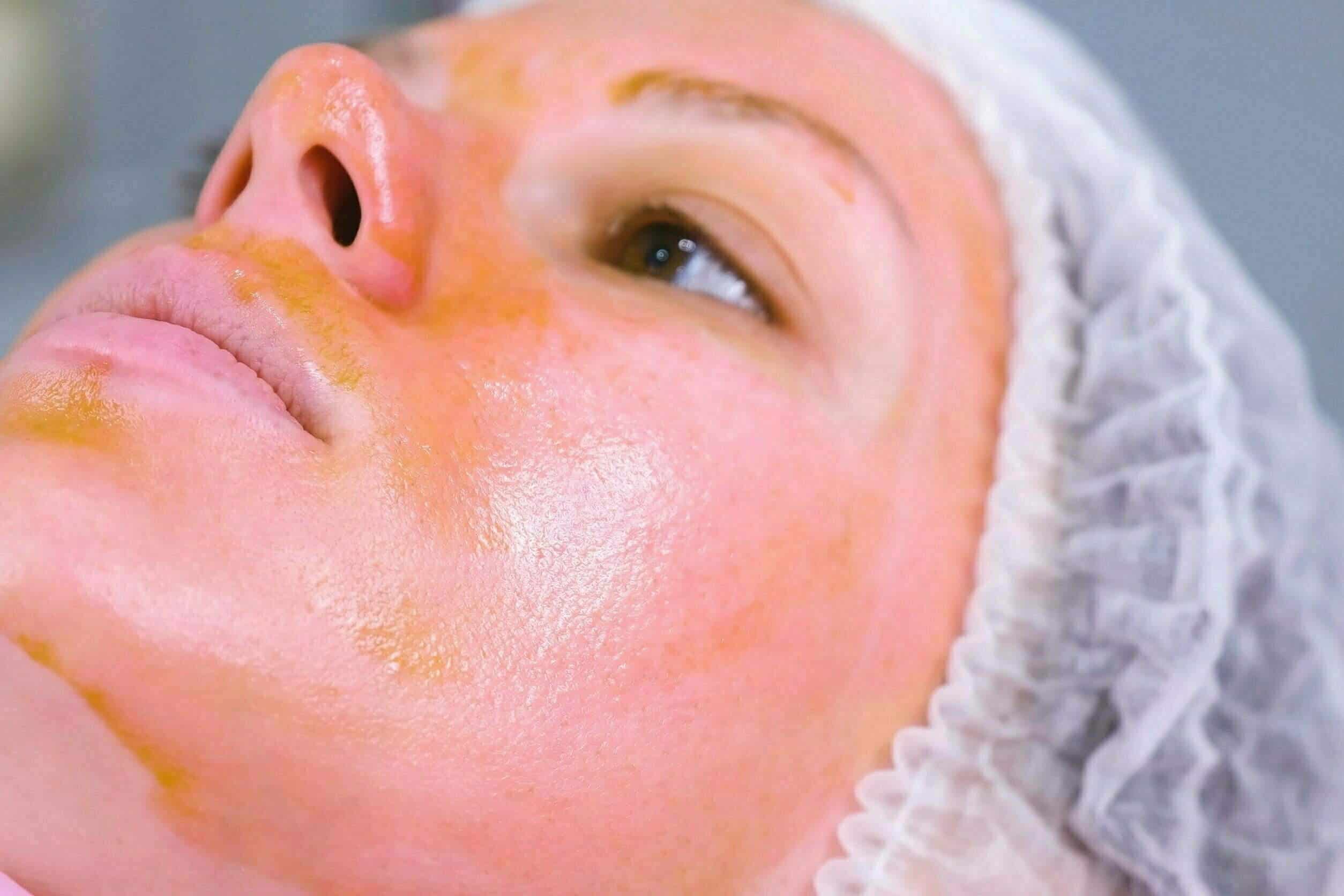 Chemical peeling o the woman’s face. Cleaning the face skin and lightening freckles skin. Close-up face. Side view.
