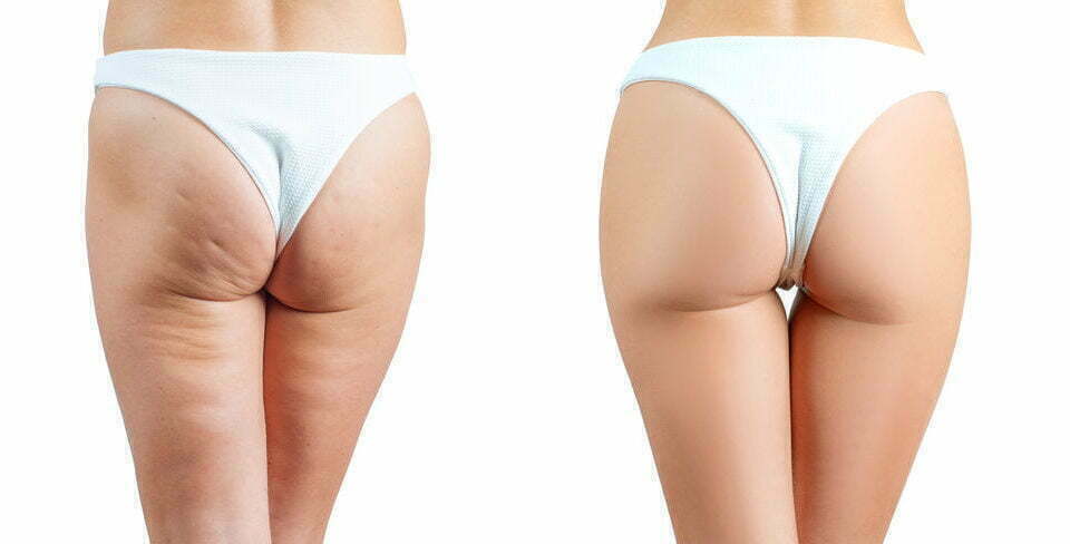 Get Summer-Ready with QWO Cellulite Treatment