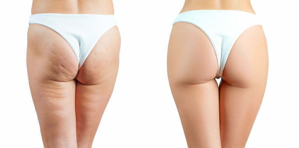 Get Summer-Ready with QWO Cellulite Treatment