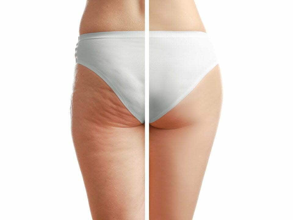 Feeling Tied Down by Cellulite?