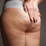 Understanding Cellulite What It Is & Why It Occurs